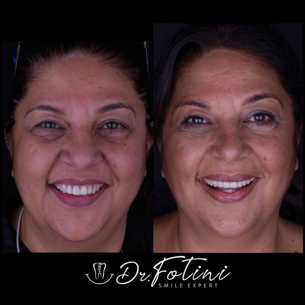 Before After Case 03