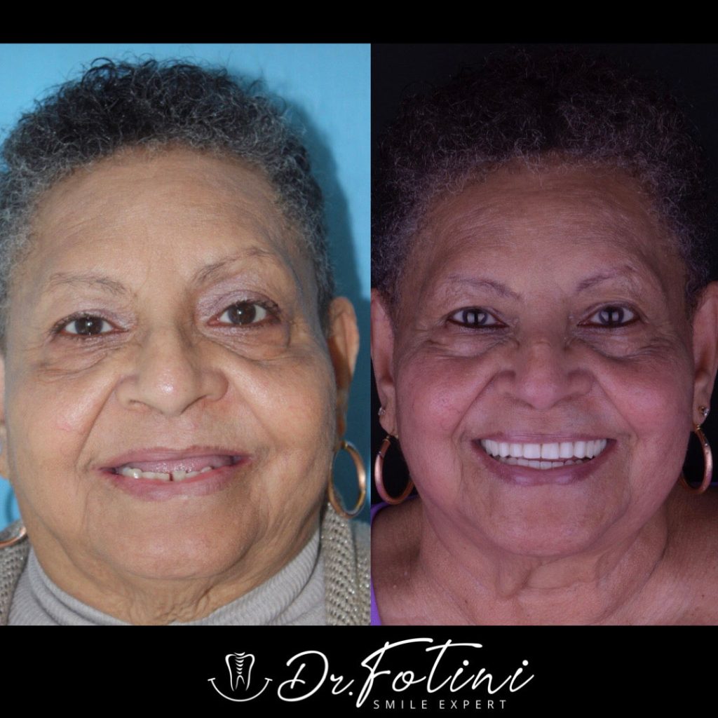 Before After Case 04