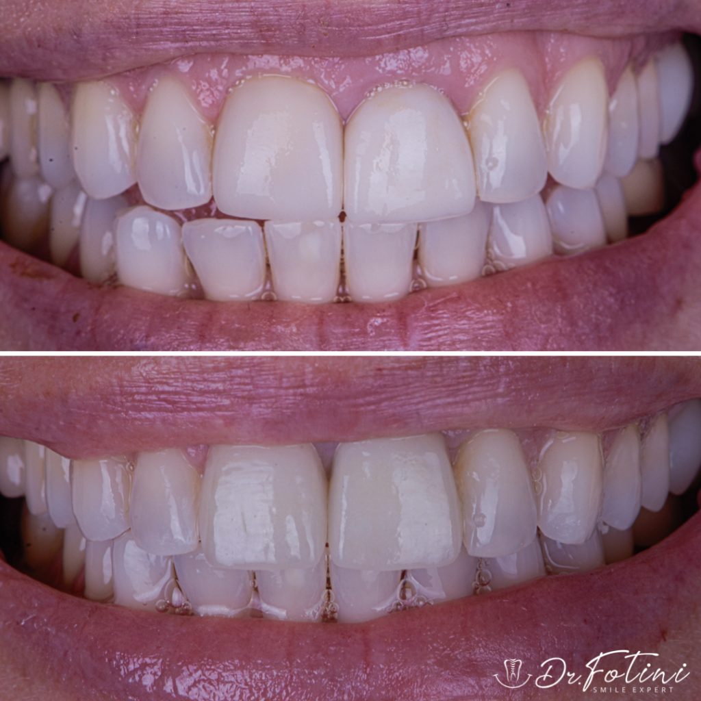 Before After Case 26