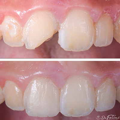 Dental Bonding before & after results Tysons, VA - Case 1
