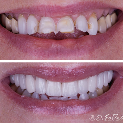 Dental Crowns before & after results - 2