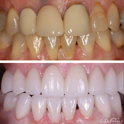 Dental Veneers before & after results Tysons, VA - Case 1