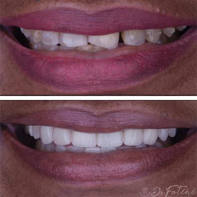 Dental Veneers before & after results Tysons, VA - Case 3