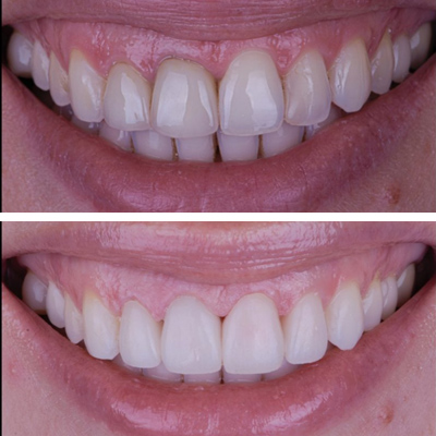 Dental Veneers before & after results Tysons, VA - Case 2