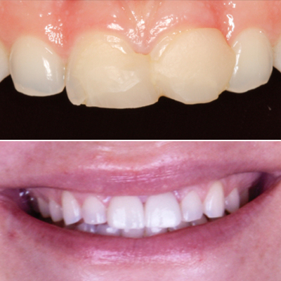 Dental Crowns before & after results - 7