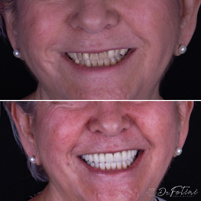 Smile Makeover, Dental Crowns and Dental Bridges before & after results - 1
