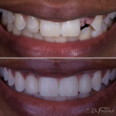 Dental Implants before & after results - 4