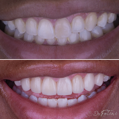 Dental Veneers before & after results - 5 in Tysons Va Area