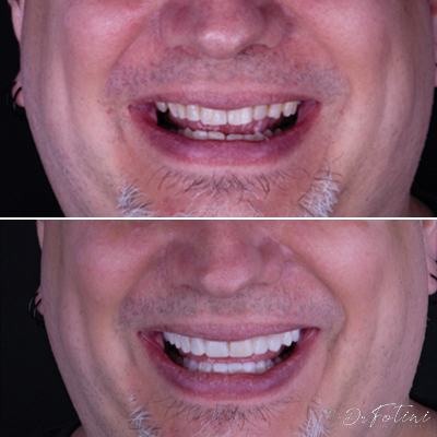 Dental Veneers before & after results - 6