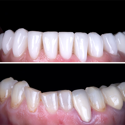 Braces before and after of a patient