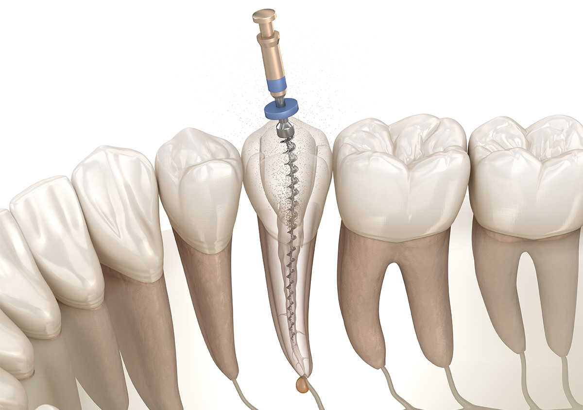 Experiencing Tooth Pain? 5 Symptoms That May Indicate a Root Canal in Tysons, VA