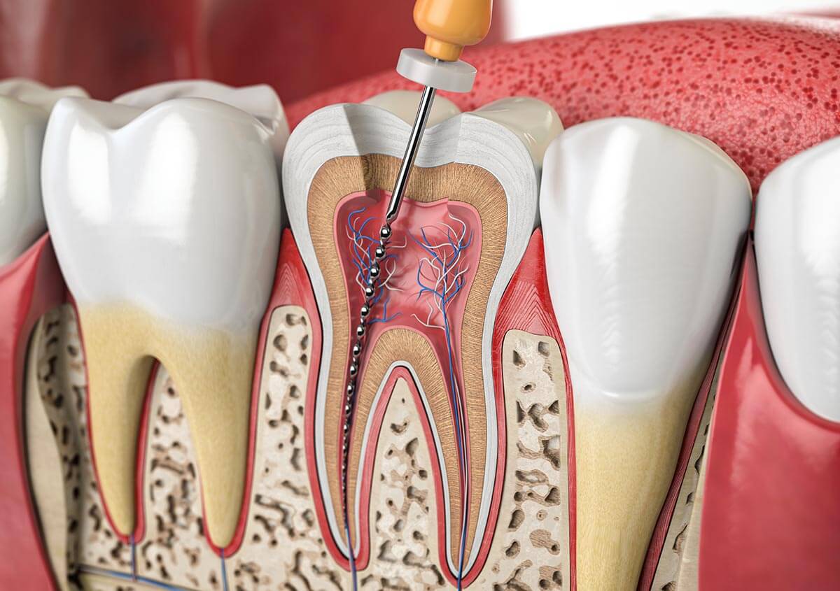 Experiencing Tooth Pain? 5 Symptoms That May Indicate a Root Canal in Tysons, VA